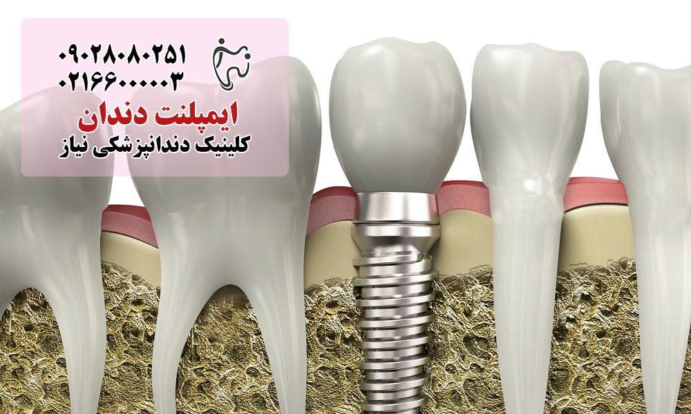 چه کسانی نمی‌توانند ایمپلنت دندان انجام دهند؟