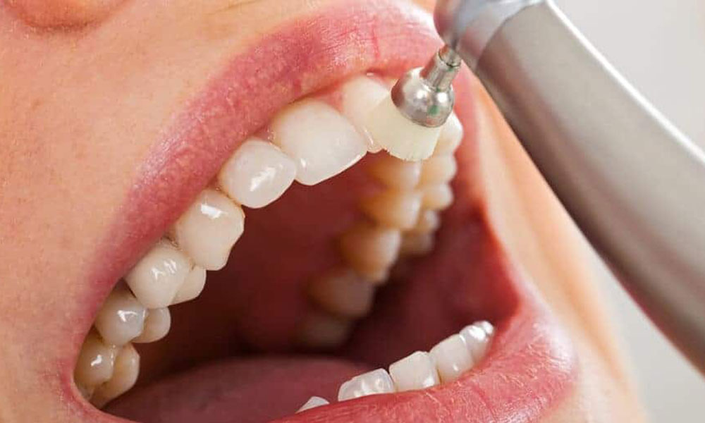 پیشگیری از لکههای سفید دندان