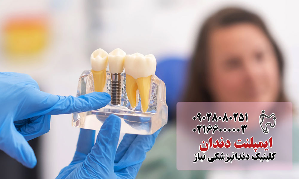ایمپلنت دندان