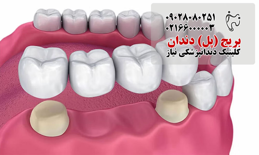 قیمت بریج دندان در غرب تهران