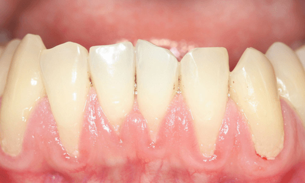 درمان عقب رفتگی لثه بر اثر ارتودنسی