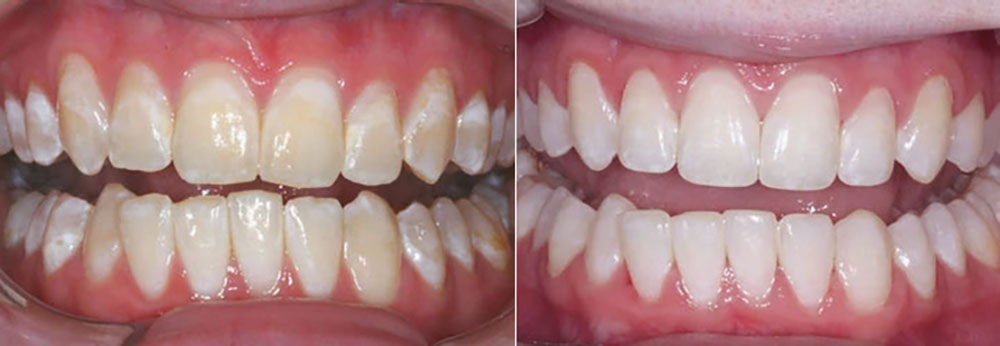 درمان‌های لکه سفید روی دندان