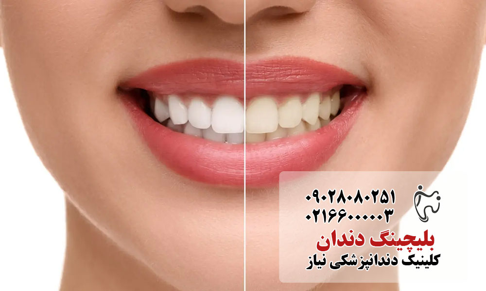 سفید کردن دندان