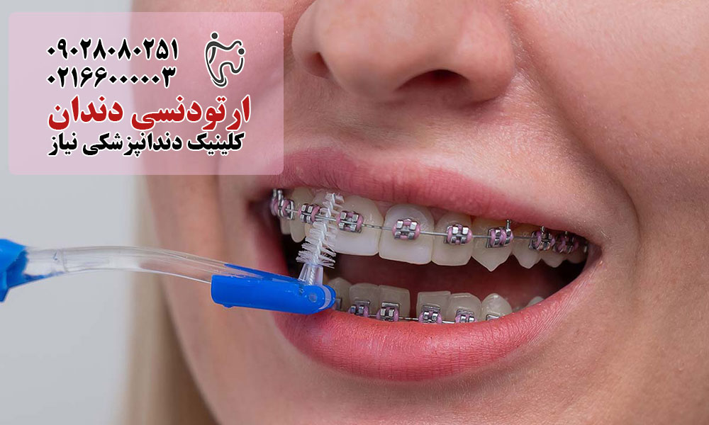 علائم پوسیدگی دندان با ارتودنسی