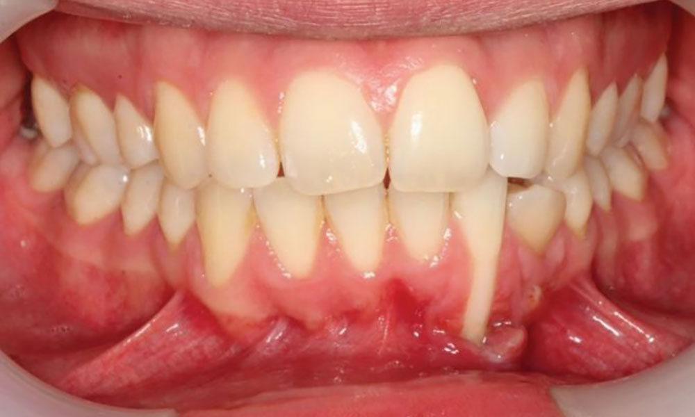 علت تحلیل لثه بر اثر ارتودنسی