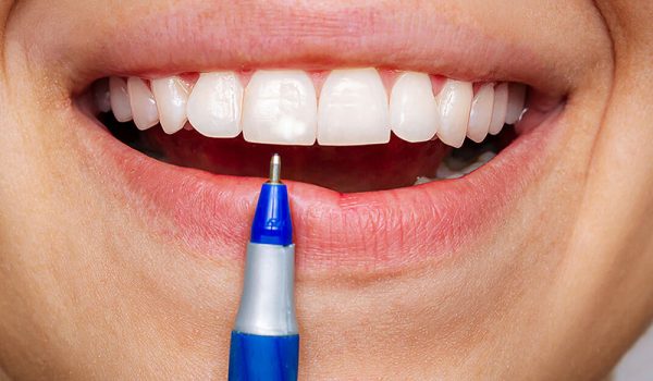 لکه‌ های سفید روی دندان‌