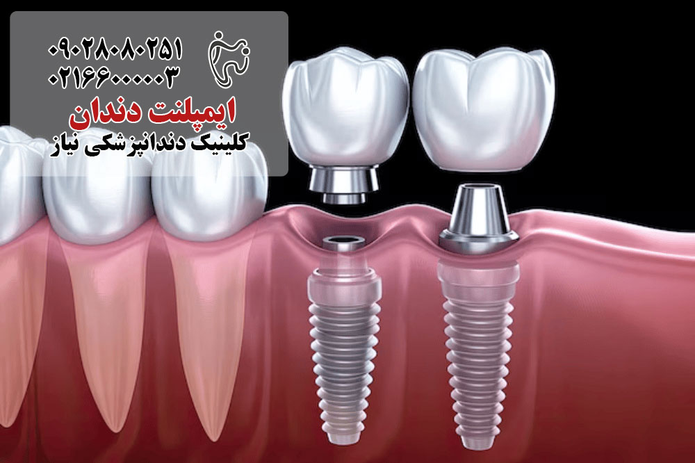 کاشت ایمپلنت دندان عقل