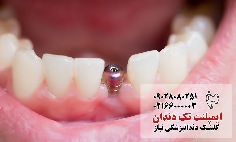 ایمپلنت تک دندان در غرب تهران