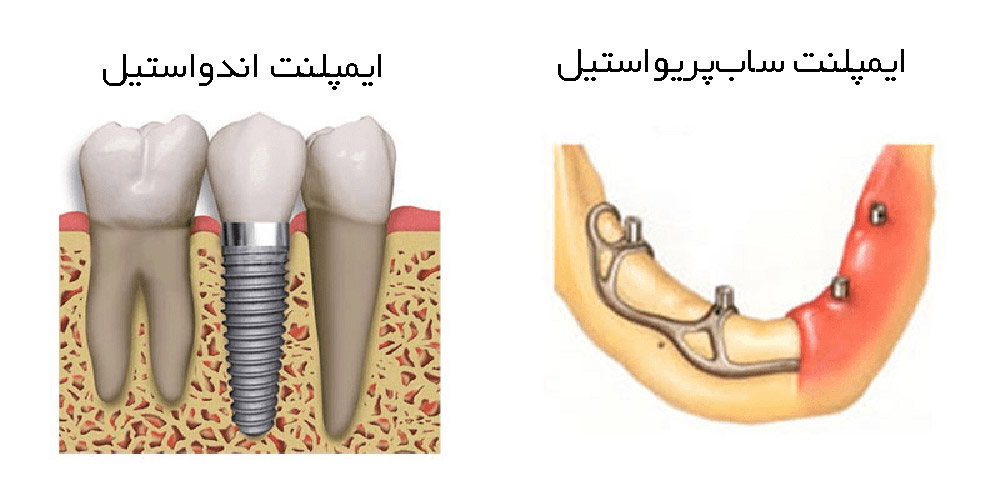 تفاوت ایمپلنت اندواستیل با ساب پریو استیل