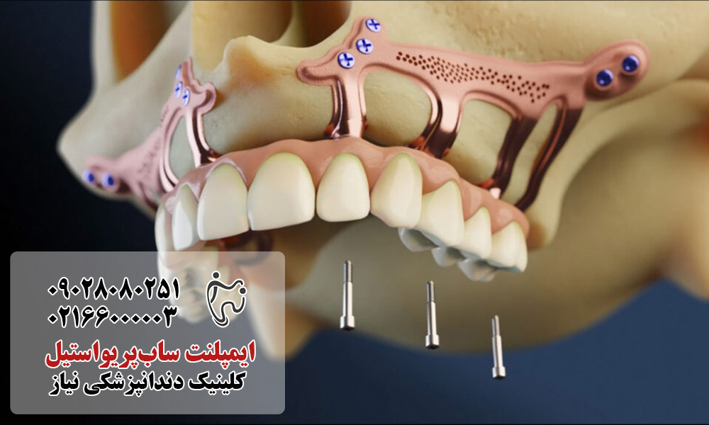 مراحل انجام ایمپلنت سابپریواستیل