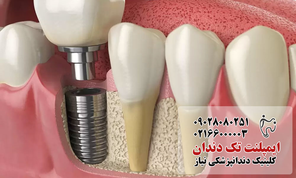 مزایای ایمپلنت تک دندان
