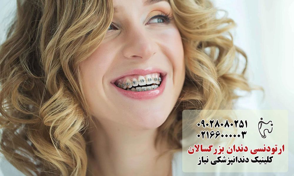 افراد مناسب ارتودنسی بزرگسالان