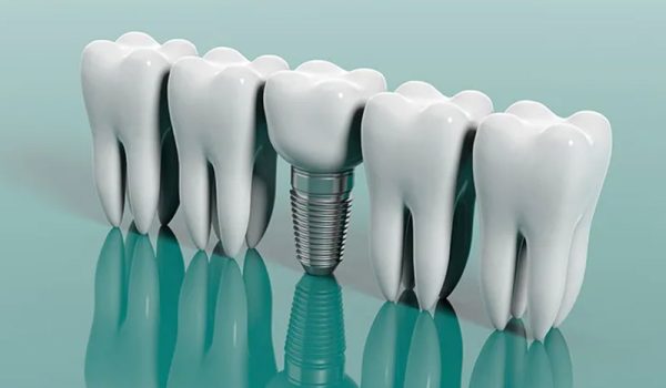 ایمپلنت اندواستیل (Endosteal Implant)