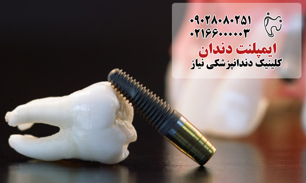 ایمپلنت در بیماران دیابتی