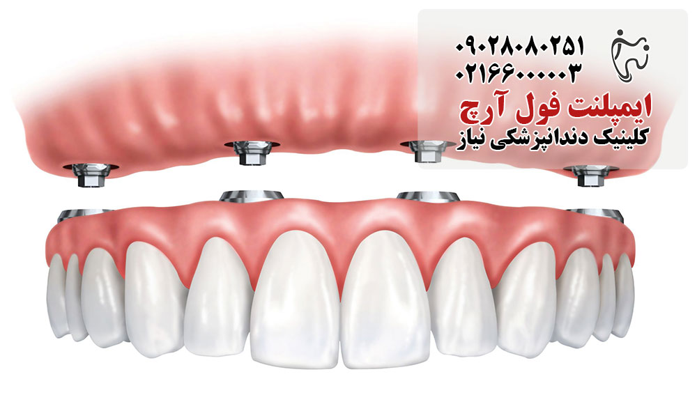 ایمپلنت فول آرچ کاشت تمام دندان‌ ها