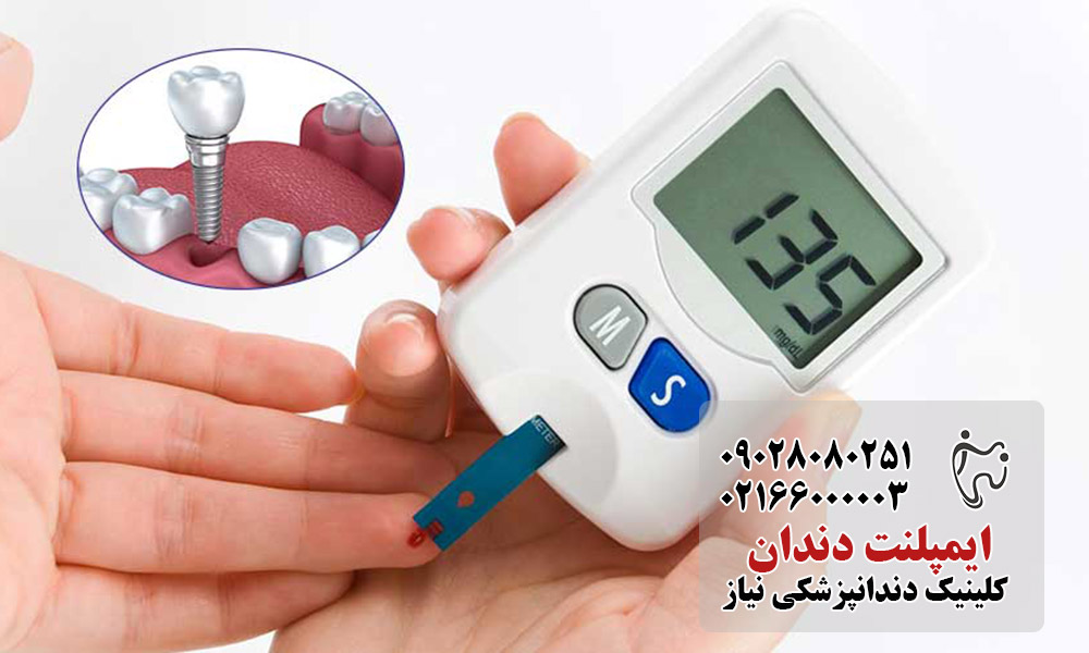 بهترین نوع ایمپلنت برای بیماران دیابتی
