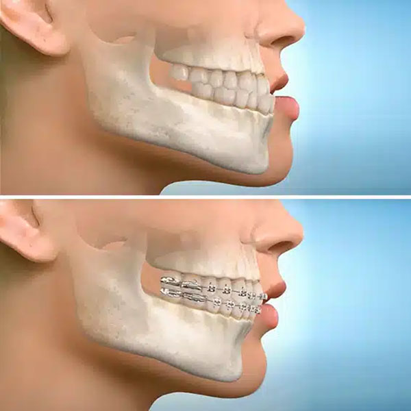 تأثیر ارتودنسی بر فرم صورت