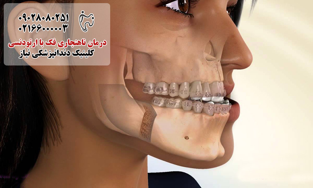 درمان ناهنجاری فک با ارتودنسی