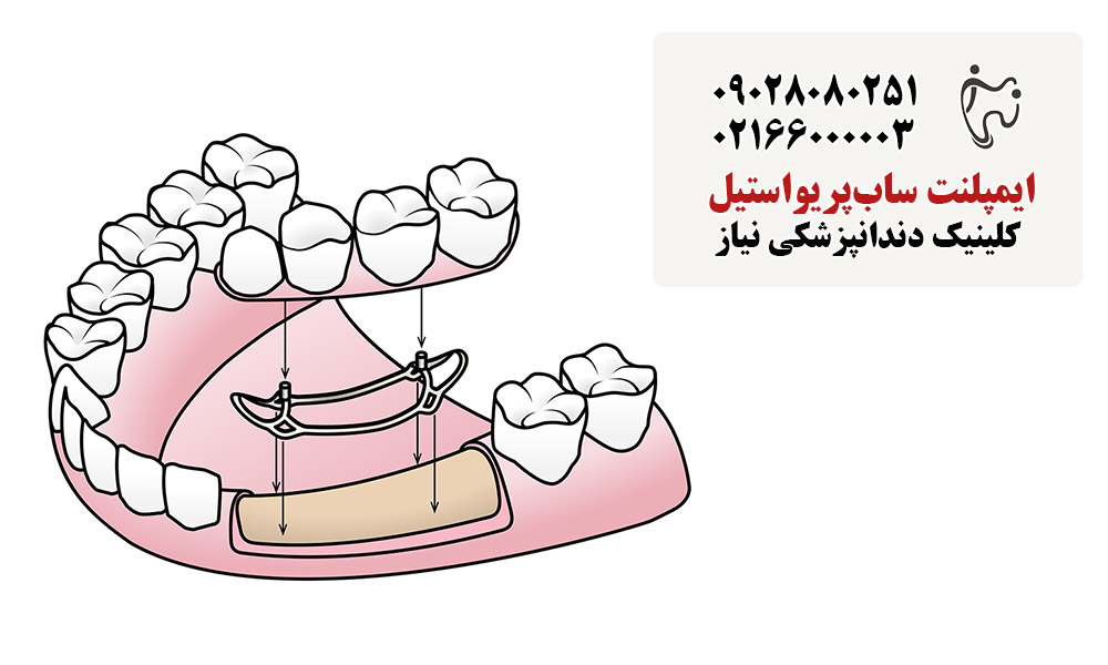 ساختار ایمپلنت ساب‌پریواستیل