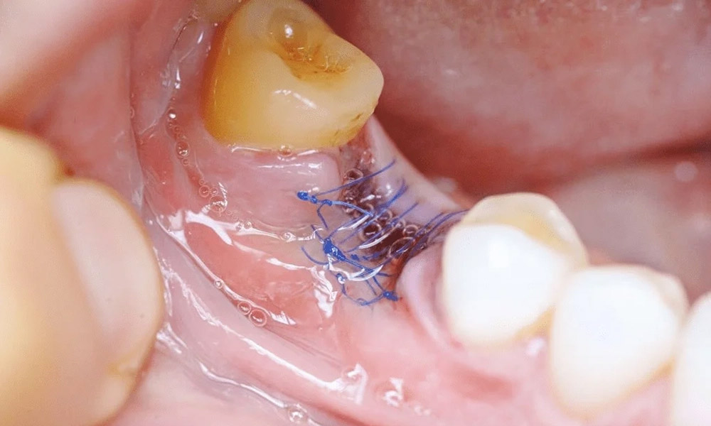 عوارض باقی ماندن دندان عقل