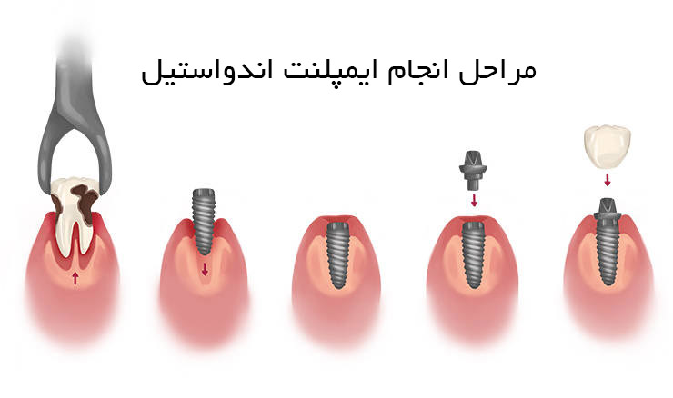 مراحل انجام ایمپلنت اندواستیل