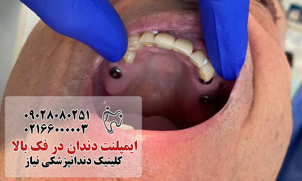 مراحل انجام ایمپلنت در فک بالا