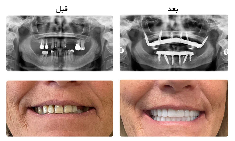 مراحل انجام ایمپلنت زیگوماتیک