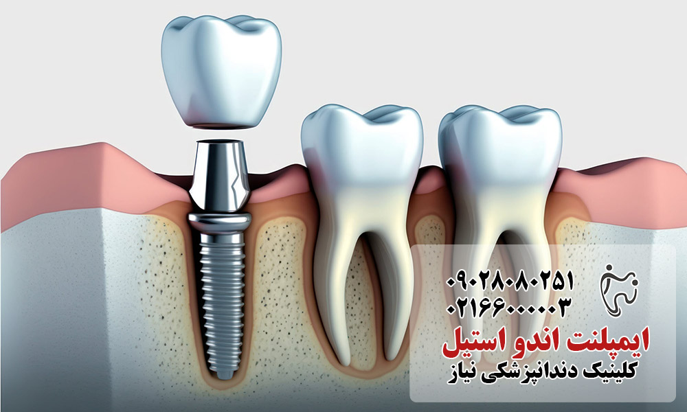 مزایای ایمپلنت اندواستیل