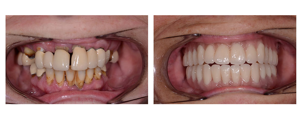 مزایای ایمپلنت زیگوماتیک