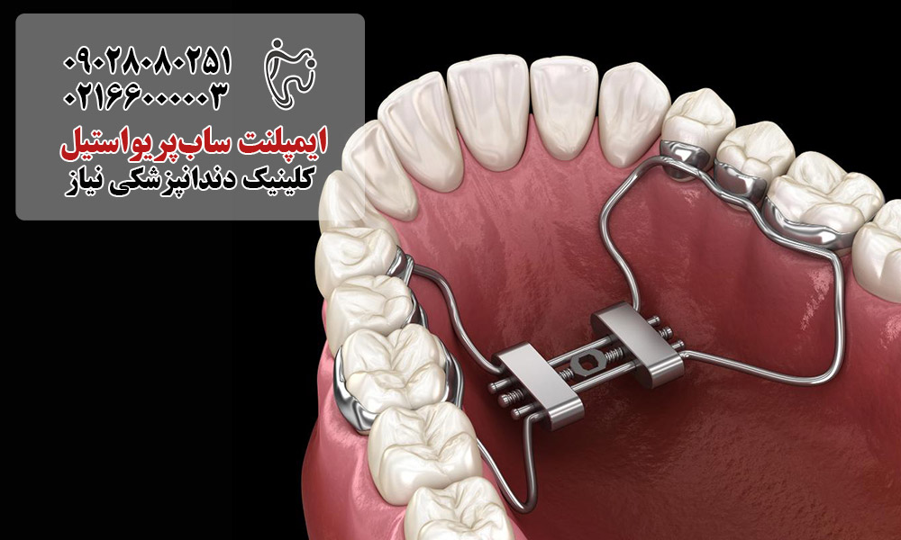 مزایای ایمپلنت ساب‌پریواستیل