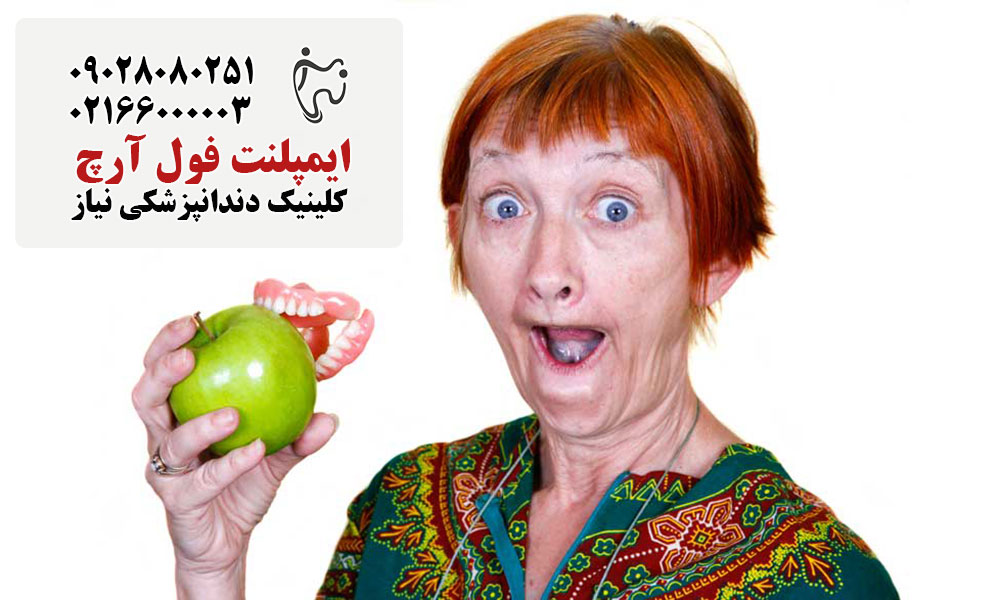 هزینه ایمپلنت فول آرچ