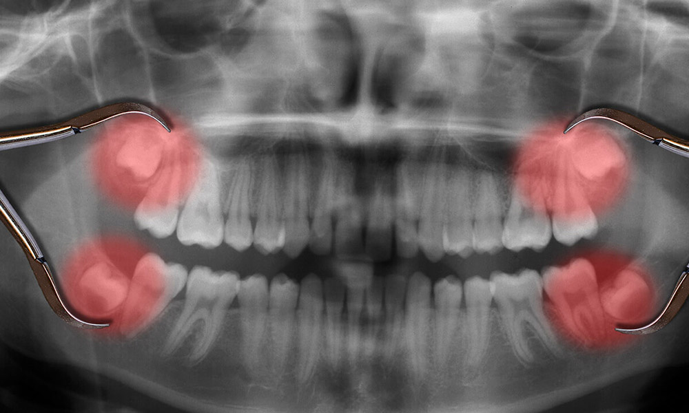 چه زمانی کشیدن دندان عقل ضروری است
