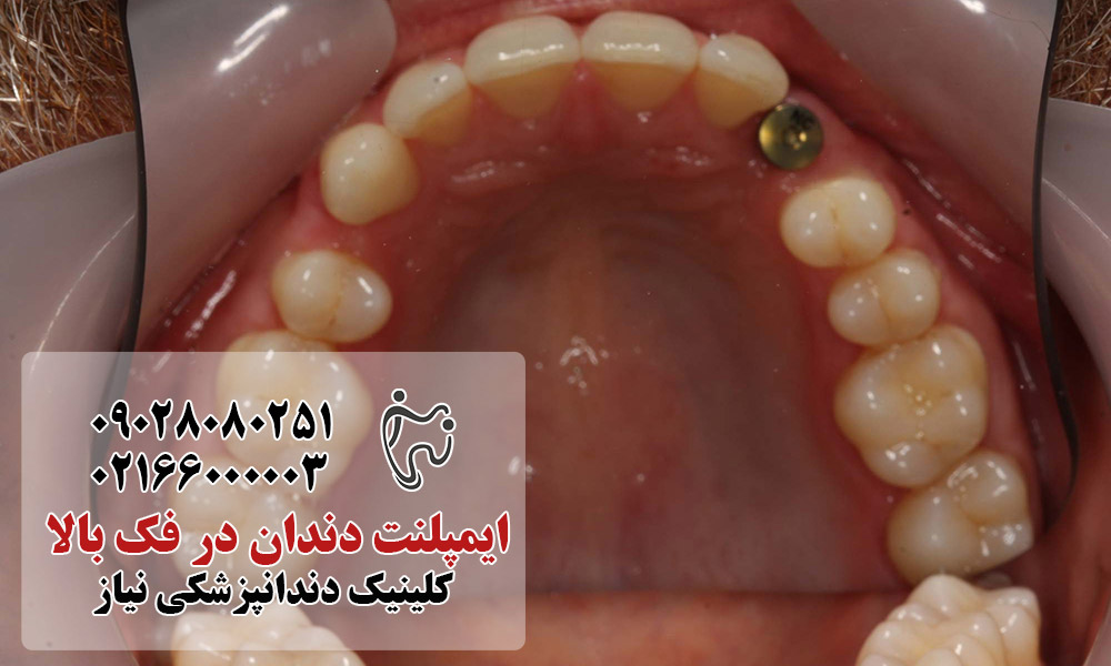 کاندیدای مناسب برای ایمپلنت در فک بالا