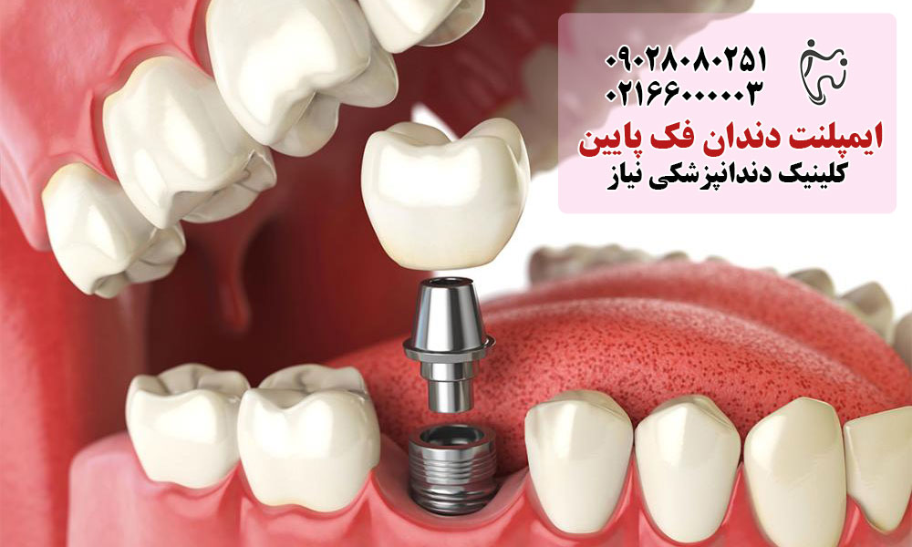 مزایای ایمپلنت دندان فک پایین