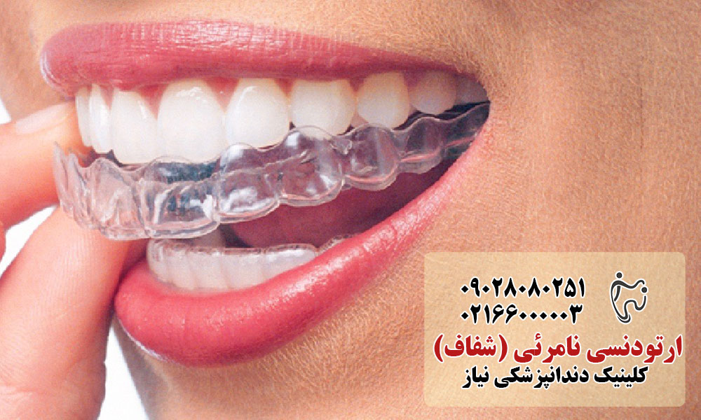 ارتودنسی نامرئی در کلینیک دندانپزشکی نیاز