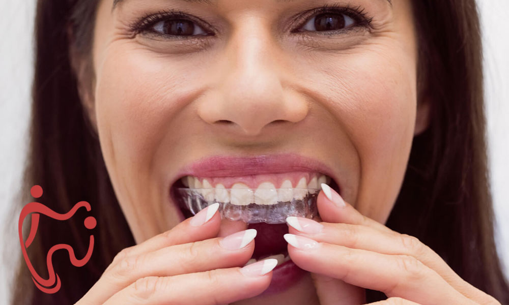 الاینر شفاف درمان فاصله بین دندانی