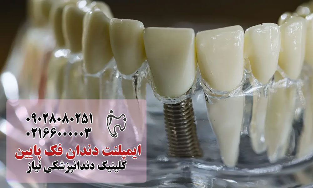 ایمپلنت دندانی فک پایین چیست