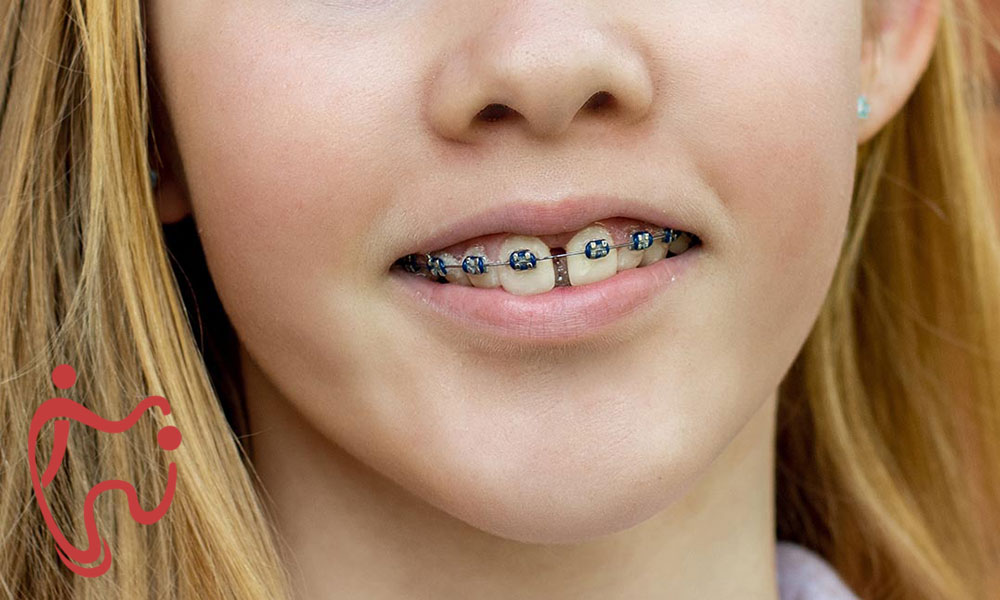 بریس سنتی درمان فاصله بین دندانی