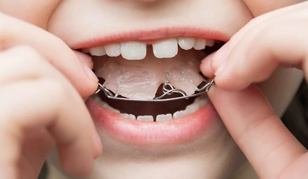 تفاوت‌ ارتودنسی نامرئی و متحرک