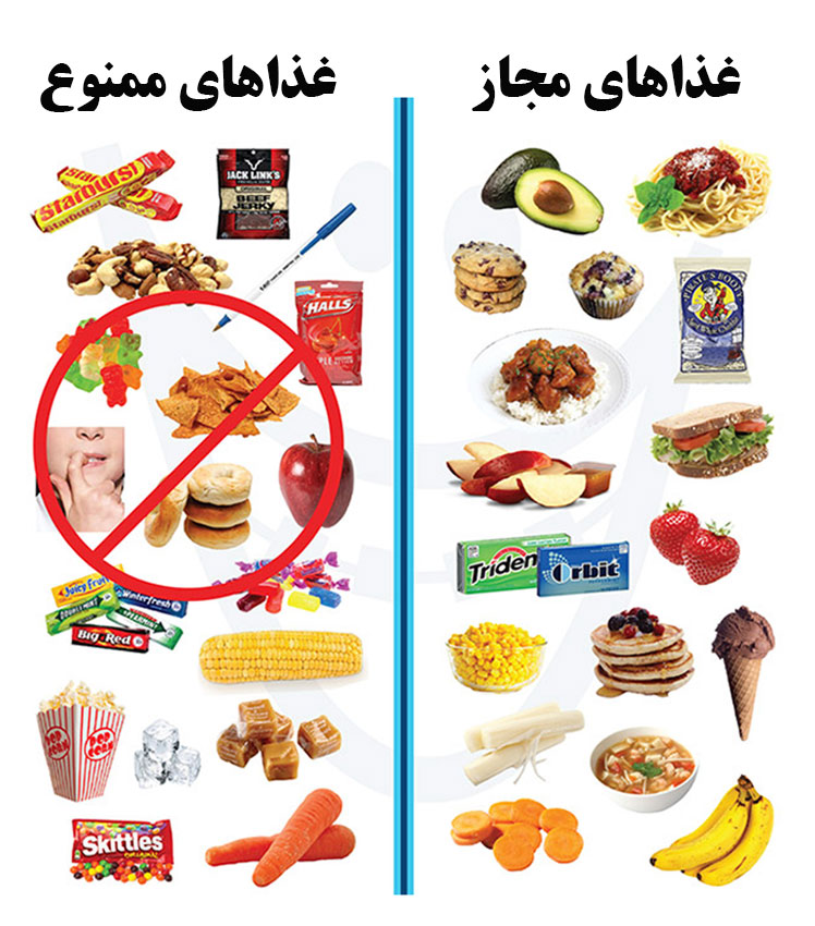 در دوران ارتودنسی چه غذایی بخوریم