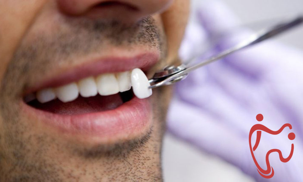 لمینت دندان (ونیر پرسلن)