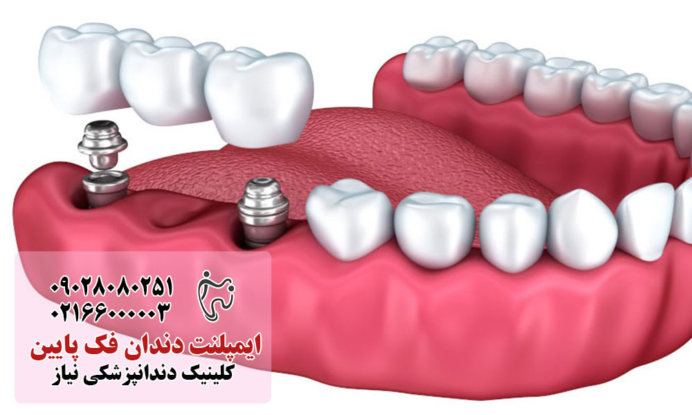 مراحل کاشت ایمپلنت فک پایین