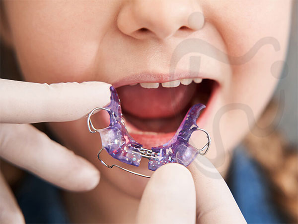 مزایای ارتودنسی متحرک