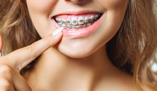 نقش ارتودنسی در درمان فاصله بین دندان‌ ها