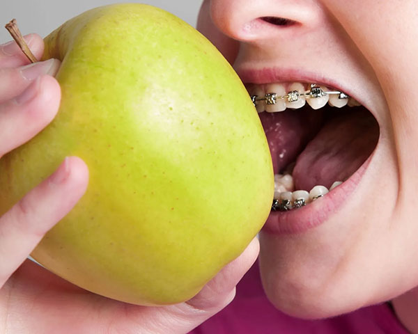 چه غذاهایی را نباید با ارتودنسی خورد؟