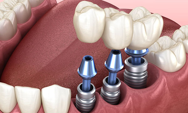 استفاده از ایمپلنت برای هر دندان