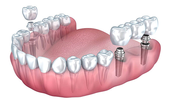 استفاده از پل متکی بر ایمپلنت