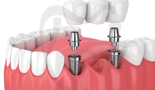 ایمپلنت برای دندان‌ های از دست رفته متوالی