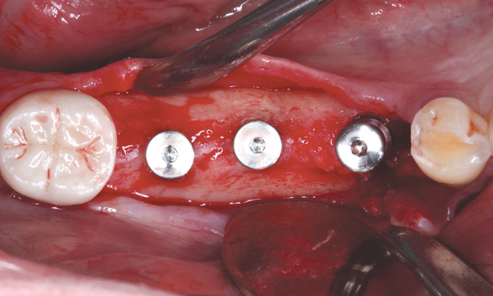 مراحل درمان ایمپلنت دندان‌ های متوالی