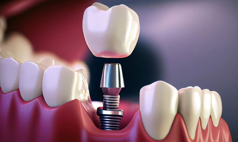 مراقبت‌های بعد از ایمپلنت دندان های متوالی